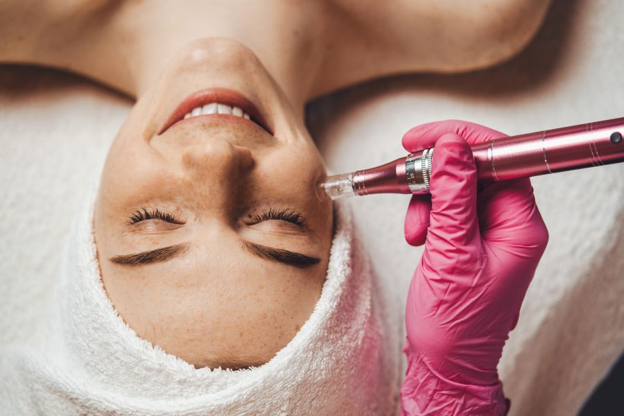 Microneedling